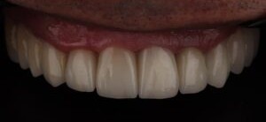 Sorriso depois do tratamento